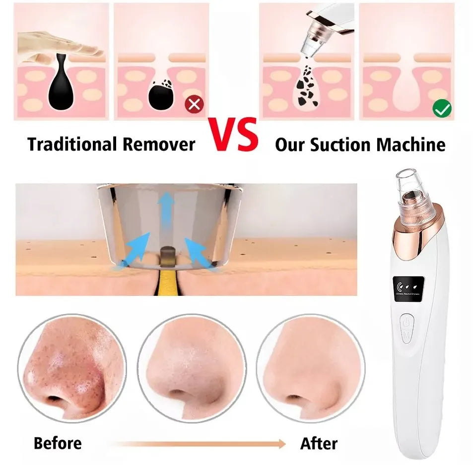 PoreClear Pro™ Electric Blackhead Remover & Pore Vacuum